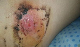 挤火疖子视频,揭秘民间传统疗法的神奇过程