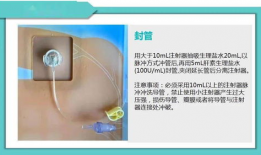 输液港维护视频