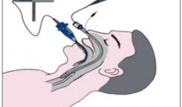 气管插管操作视频,关键步骤与技巧解析